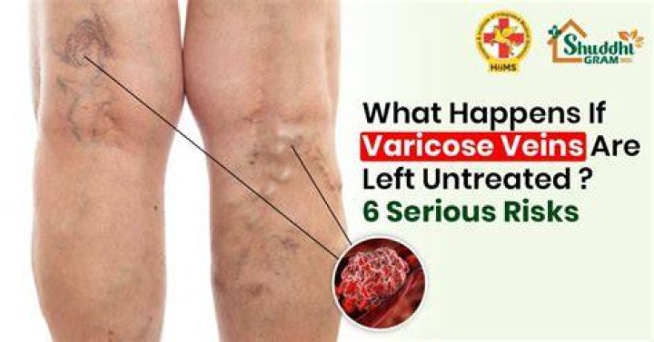 What happens if varicose veins are left untreated?