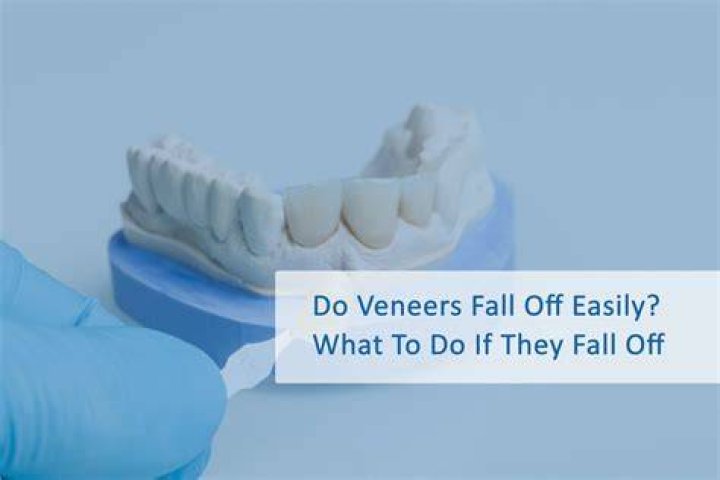 What happens when veneers fall off?
