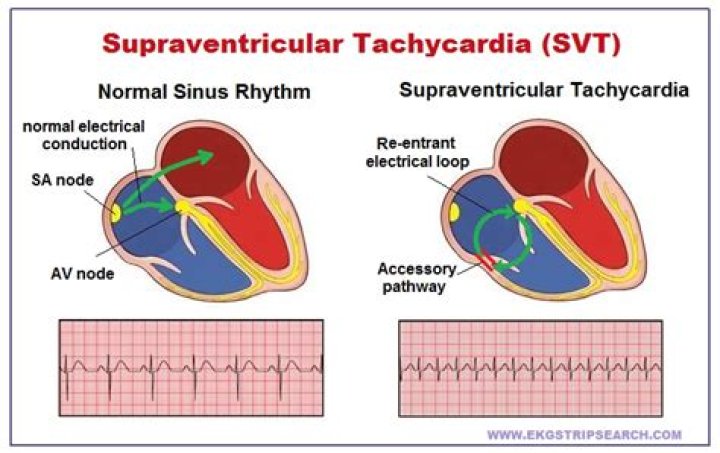 What is SV heart?