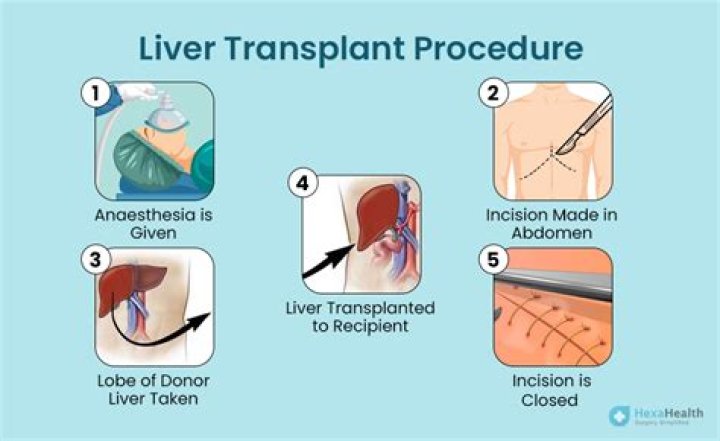 What is the best liver transplant hospital?