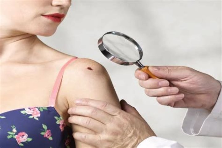 What kills melanoma?