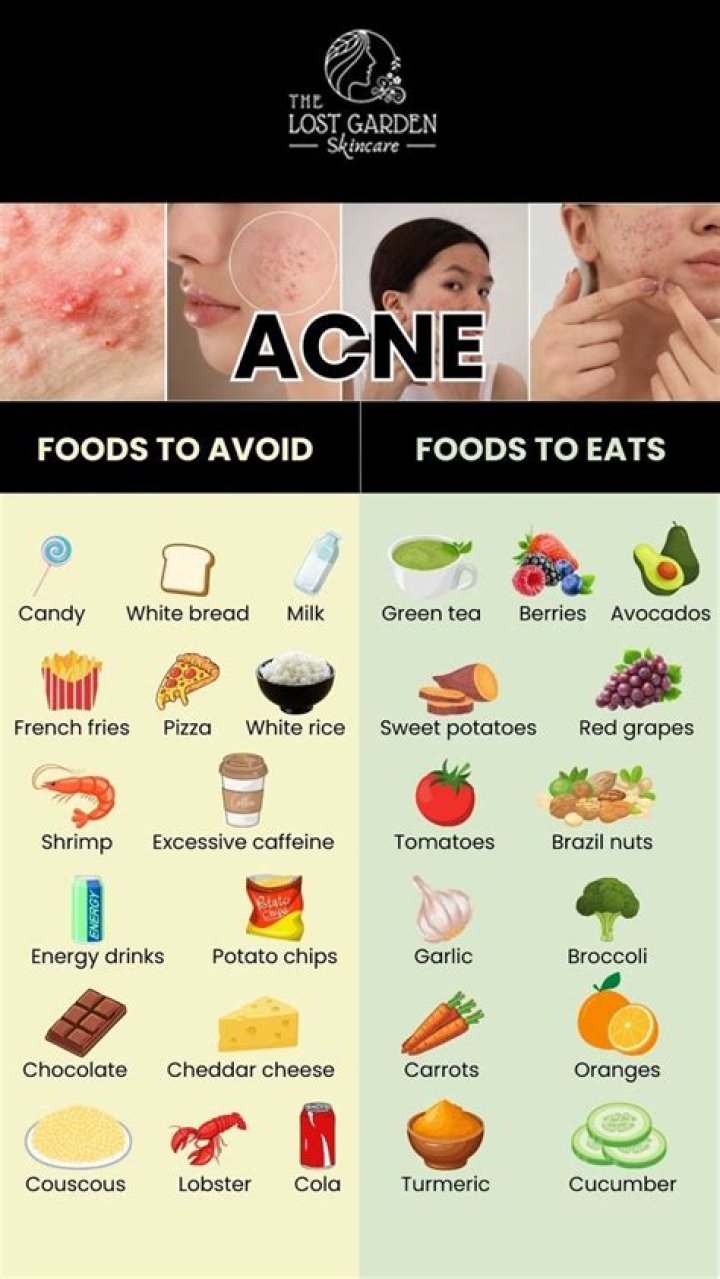 What should you not do with acne?