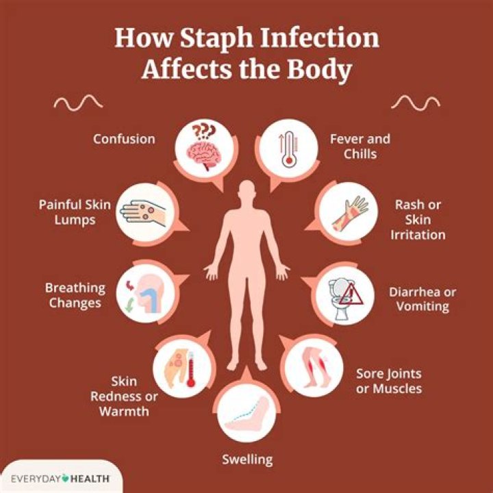 When should I be worried about a staph infection?