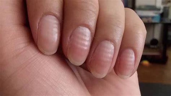 Why are my nails bumpy?