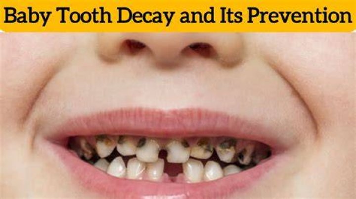 Why are my toddler's teeth decaying?