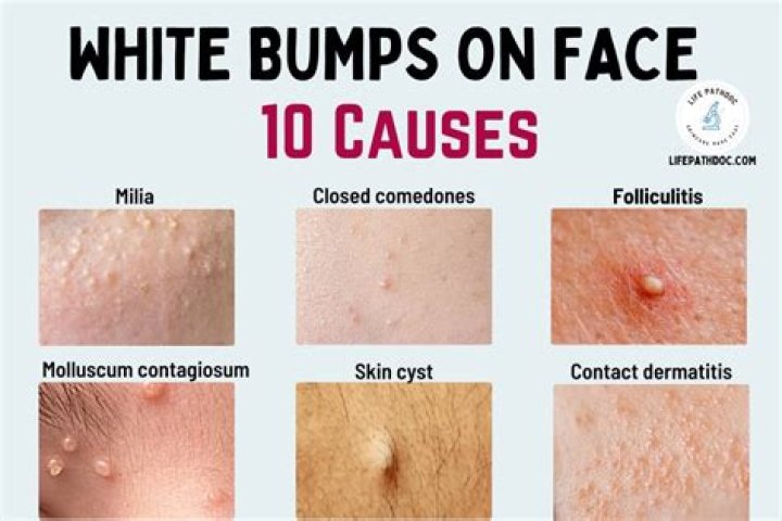Why do pimples come on face?