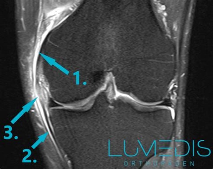 Wie lange dauert ein Innenbandriss im Knie?